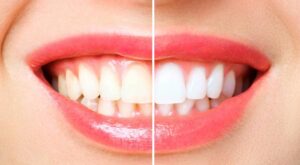 5 Tips for Teeth Whitening 